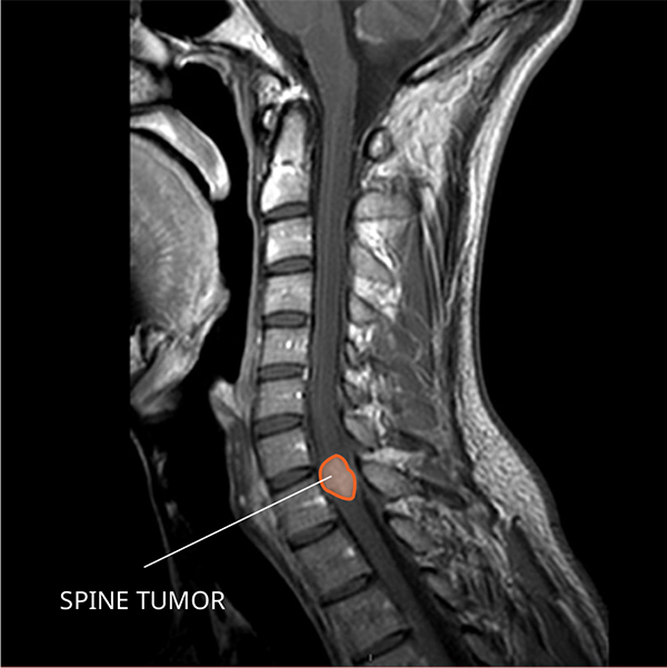 ependymoma-national-cancer-institute